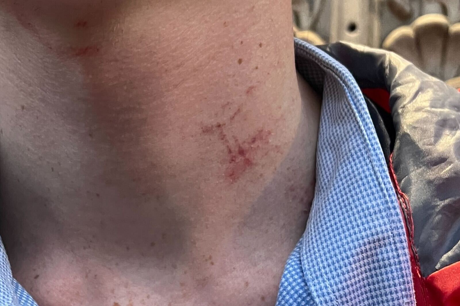 Protester from the Labour party conference shows the scratches on his neck