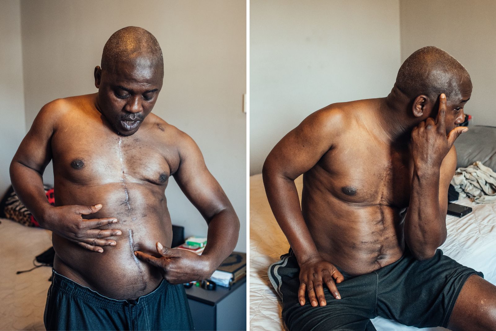 A composite image comprised of two photographs of Alieu Barry, in his room with his shirt off, showing the scars he carries after being stabbed 16 times by a dispersal accommodation housemate